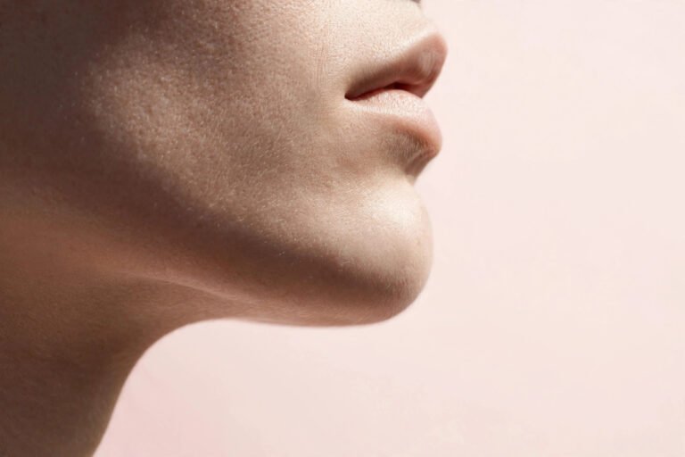 Hormonal Acne on Chin & Jawline: Causes and Treatment